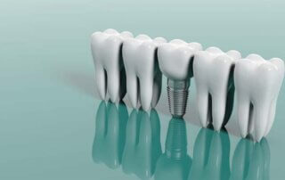 basarisiz-implant-belirtileri-iplant-islemi-basarisiz-olursa-320×202 basarisiz-implant-belirtileri-iplant-islemi-basarisiz-olursa-320x202