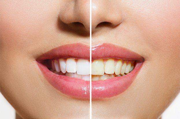 Diş Beyazlatma Tedavisinden Sonra Dişler Tekrar Sararır mı?