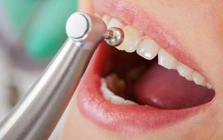 Diş Taşı Nedir? Diş Taşı Temizliği Zararlı mıdır?