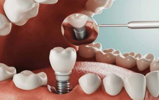 Diş İmplant Tedavisi Nedir, Nasıl Yapılır, Tedavi Ne Kadar Sürer?