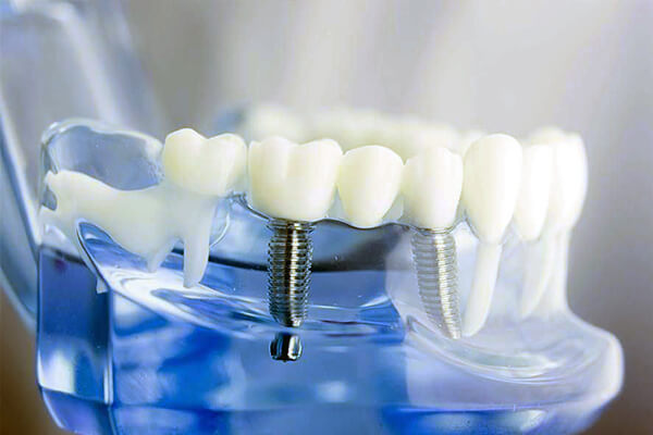 İmplant Uygulama Durumları implant tedavisi uygulamaları, implant tedavisi uygulama şekilleri, implant uygulamaları, implant uygulaması