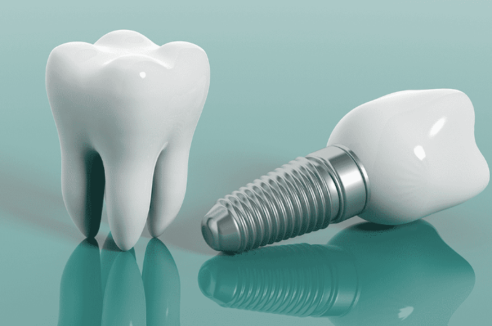Nişantaşı İmplant Tedavisi İşlemleri Nişantaşı implant tedavisi, implant tedavisi, istanbul nişantaşı implant tedavisi